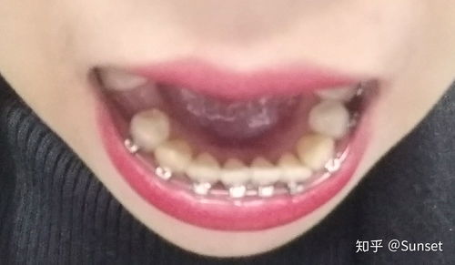 我的正畸之旅 在河源恒信口腔醫院的口腔新生